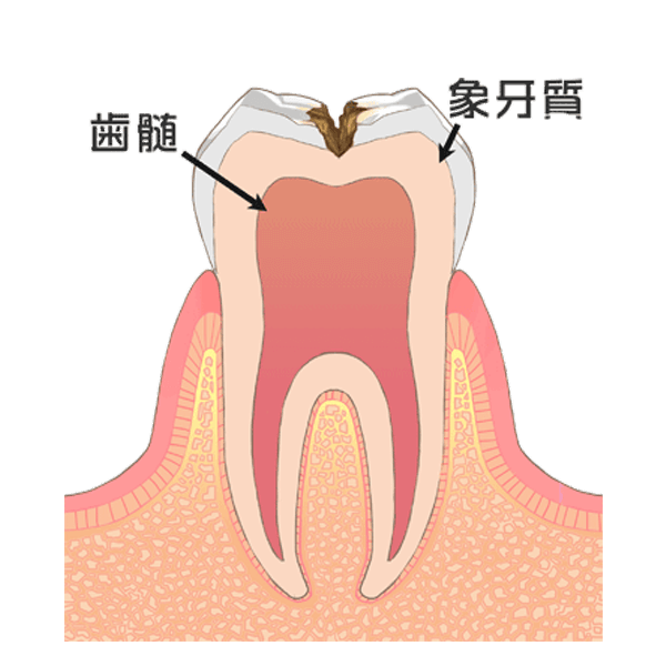 Ｃ２：歯の中（象牙質）の虫歯