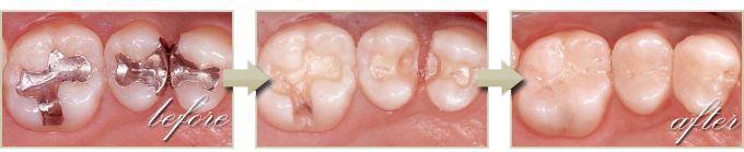 銀歯を白い歯への治療症例1