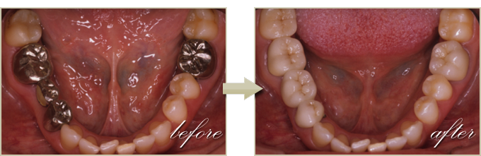銀歯を白い歯への治療症例3