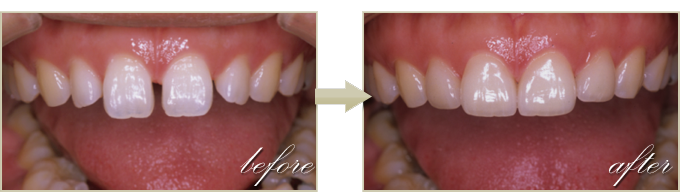 前歯・歯並びの治療症例2