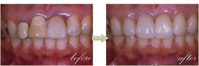 前歯・歯並びの治療症例3