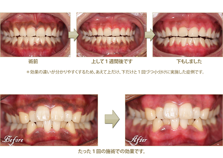 歯茎の黒ずみ取りの治療症例1
