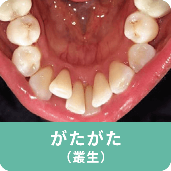 がたがた（叢生）