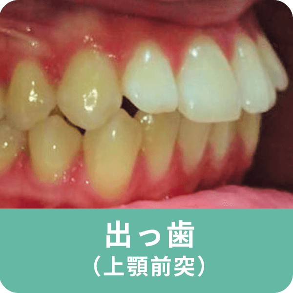出っ歯（上顎前突）