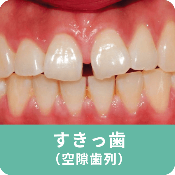 すきっ歯（空隙歯列）