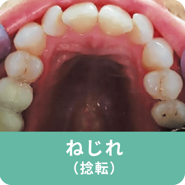 開咬